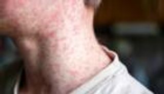 عنقود يوم البوكسينغ.. كيف تسبب مسافر واحد في تفشي الحصبة بأستراليا؟