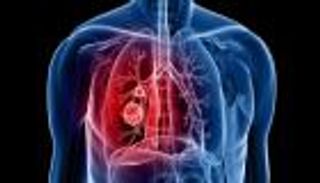 بكتيريا الأمعاء.. سلاح غير متوقع ضد سرطان الرئة