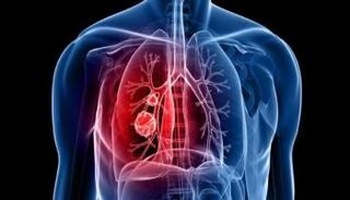 مركبا صغيرا تنتجه ميكروبات بالأمعاء يضاعف استجابة سرطان الرئة لعلاجات المناعة