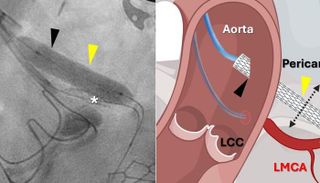 أول جراحة لتحويل مسار الشريان التاجي دون فتح الصدر