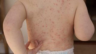 تفشٍ متسارع للحصبة بكارولاينا الجنوبية بأمريكا