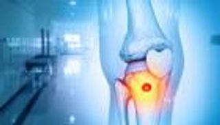 &laquo;جزيئات خارقة&raquo; تدخل عظام المرضى لتقتل السرطان وتخفف الألم