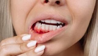 نزيف اللثة قد ينذر بخطر يهدد الكلى